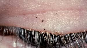 Image result for pubic lice symptoms