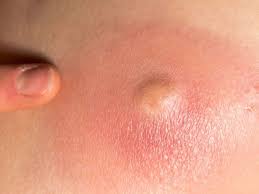 Boils are fairly common and can be easily boils may be mistaken for cysts or have cysts beneath them, which requires treatment by a doctor.2 x research source. How To Get The Core Out Of A Boil What To Do