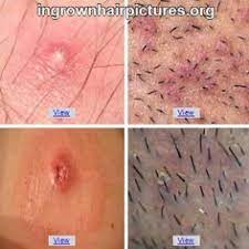 Ingrown hairs do not demonstrate additional symptoms unless they lead to a more serious infection like sepsis. Herpes Or Ingrown Hair