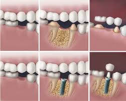 Although more studies are needed to confirm the potency of oil pulling at preventing cavities, oil pulling has been named as a method to prevent cavity. Teeth Replacement Teeth Replacement Cost In Chennai Acharya Dental