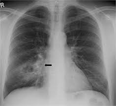 Image result for Lung Abscess