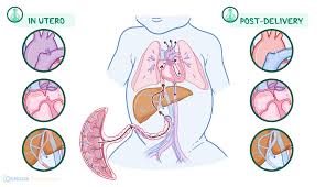 Image result for Delayed Transition from Fetal Circulation