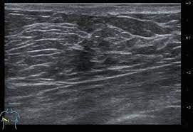 The use of ultrasound for breast cancer screening. Healthy Breast With Ultrasound Radiology Key