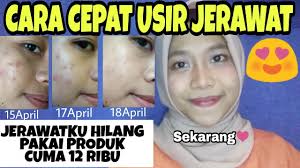 Untuk menghilangkan jerawat sekaligus bekas jerawatnya. Cara Menghilangkan Jerawat Dengan Cepat Dan Bekasnya By Khairunnisa Adlina Youtube