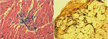 More specifically, it is described as. Myocarditis In Clinical Practice Mayo Clinic Proceedings