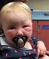There are four main types of sun allergy: Mom Urges Do Not Buy This Harmful Sunscreen After 3 Month Old Is Hospitalized For 3 Days From Burns