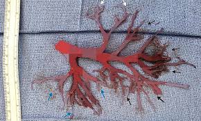 Pulmonary hypertension, or high blood pressure, can develop when the arteries are narrowed or blocked, leading to coughing and spitting up blood from the lungs. Man 36 Literally Coughed Up Part Of His Lung After He Was Hospitalized With Heart Palpitations Daily Mail Online