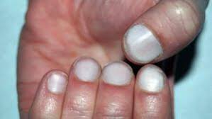Terry's nails: Appearance, causes, and treatment