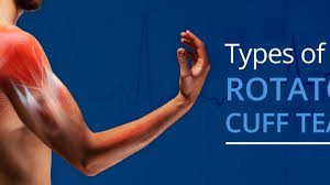 The anterior compartment includes biceps brachii, coracobrachialis and brachialis while the triceps brachii is a. Types Of Rotator Cuff Tears Orthobethesda
