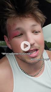 What Happened to Matthew Scrivs Eye