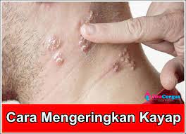 Ayam kampung merupakan salah satu jenis ternak unggas yang telah memasyarakat dan tersebar di seluruh pelosok nusantara. Testimonial Ubat Kayap Secara Semulajadi Tradisional Ubat Kayap Shaklee 9
