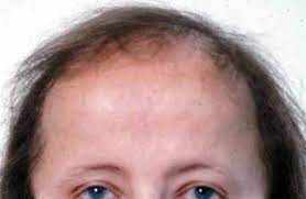 Alcohol is said to suck the body of its iron supply, thereby hampering the absorption of zinc. Androgenetic Alopecia Medlineplus Genetics