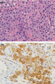 Lymphomas with intermediate features, advances in hematology, vol. Aggressive B Cell Lymphomas In The Update Of The 4th Edition Of The World Health Organization Classification Of Haematopoietic And Lymphatic Tissues Refinements Of The Classification New Entities And Genetic Findings Ott
