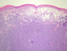 Merkel cell carcinoma is a highly aggressive primary cutaneous neuroendocrine carcinoma primarily affecting elderly and immunosuppressed individuals. Merkel Cell Carcinoma Pathology Dermnet Nz