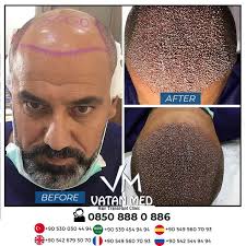 5000 Greft Ordu Sakal Sac