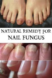 Natural Remedy For Nail Fungus Everything In One Place In 2020 Nail Fungus Remedy Nail Fungus Cure Toenail Fungus Remedies