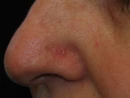 Sensation that something is different. Basal Cell Carcinoma Affecting The Nose Images Dermnet Nz