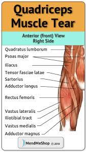 Surgical management of quadriceps strain. Quadriceps Muscle Strain