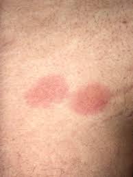 Image result for Urticaria pigmentosa children