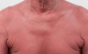 Some skin lymphomas appear as a rash over some or most of the body (known as erythroderma). Lymphoma Action Skin Lymphoma