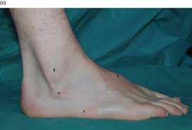 Image result for Probe-to-Bone Test