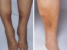 Image result for Lipodermatosclerosis