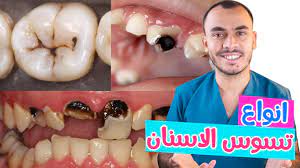 انواع تسوس الاسنان اعرف انت اى نوع فيهم youtube