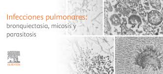 La mucormicosis es una infección por hongos saprofitos de la cavidad nasal y senos paranasales de los géneros mucor, absidia y rhizopus. Infecciones Pulmonares Bronquiectasia Micosis Y Parasitosis