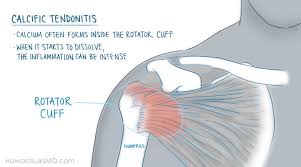 The collection of muscles and tendons in the shoulder is known as the rotator cuff. Rotator Cuff Tears And Shoulder Pain At Night