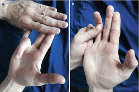 The available tests for demonstrating the action of flexor digitorum superficialis (fds) can be used on one finger at a time. Flexor Tendon Injuries Of The Upper Extremity Springerlink