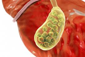 So how does exercise reduce your risk of getting gallstones? Gallbladder Inflammation Symptoms Signs Complications And Causes