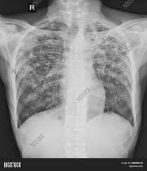 On radiograph tubercular lesions of lung parenxyma, stroma comes to light as shadows (densities, consolidations). Pulmonary Tuberculosis Image Photo Free Trial Bigstock