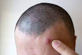 Die ersten haare sind noch dünn und fein. Pickel Nach Der Haartransplantation Ausdrucken Tophairclinic