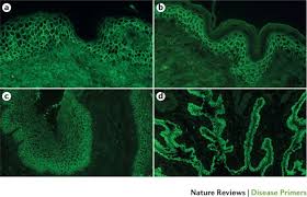 Image result for Pemphigus