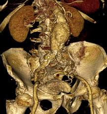 Un diámetro de la aorta abdominal ≥ 3 cm constituye en forma típica un aneurisma aórtico abdominal. Reconstrucao Tridimensional Em Angiotc De Aneurisma Da Aorta Abdominal Download Scientific Diagram