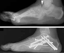 Charcot foot disorder is a medical condition that leads to weakening of the bones in the foot. Diabetic Charcot Foot Orthoinfo Aaos