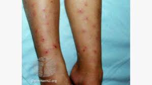 Image result for Papular urticaria