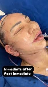 Así va la cosa al año de operada de un estiramiento facial quirúrgico tipo  lifting de Deep plane.