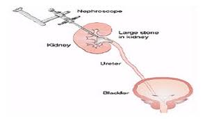 Kidney Stone Treatment In Kerala Urinary Stone Treatment Kerala