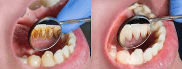 We had our cat's teeth cleaned about a year ago and paid $199 for cleaning and anesthesia (but no other services included). How Much Does A Teeth Cleaning Cost Teethwalls