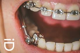 The devices carefully apply pressure to adjust the teeth into the correct alignment. Explaining The Purpose Of Mandibular Advancement To Correct Smiles
