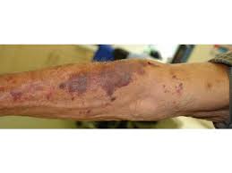 Image result for Skin Tear