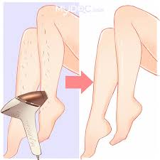 Ipl hair removal is more durable than traditional hair removal methods. Best Ipl Hair Removal In Rawang Price Guide Reviews