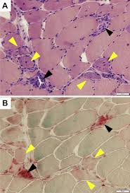 This means that the cancer cells have spread beyond the colon to surrounding organs or distant parts of the body. Metastatic Colon Cancer Presenting With Immune Mediated Necrotizing Myopathy Clinical Colorectal Cancer
