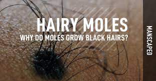 Folliculitis can affect any part of the body that has hair. Hairy Moles Why Do Moles Grow Black Hairs Manscaped Com Manscaped