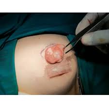 Breast lump surgery