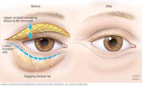 Scarless eye bag removal treatment. Bags Under Eyes Diagnosis And Treatment Mayo Clinic