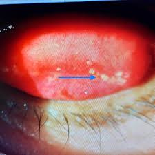 Image result for Conjunctival Foreign Body