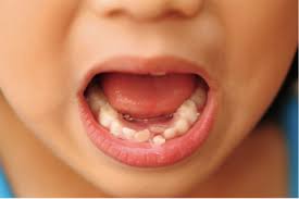 What Are Shark Teeth And Should I Be Worried Kiddies Dental Care