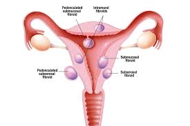 Fibroids Nhs